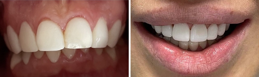 Before & After Photo case Veneers 8