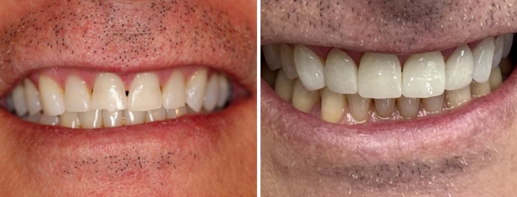 Veneers Case 1