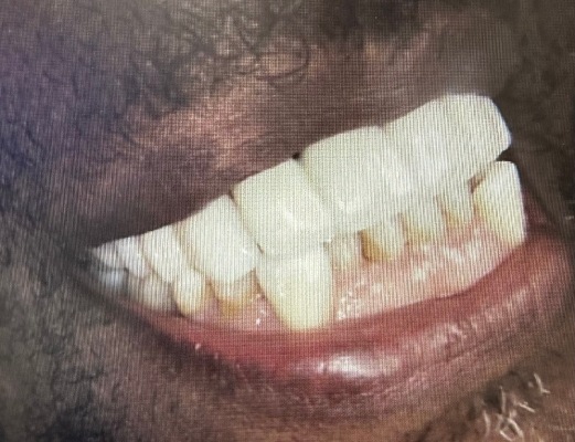 Close-up of a patient's teeth with a zirconia bridge installed on the upper jaw