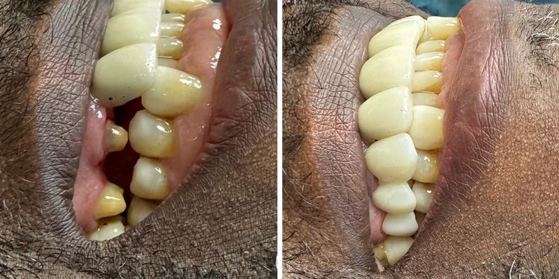Patient's teeth before and after the placement of a zirconia bridge on the upper jaw