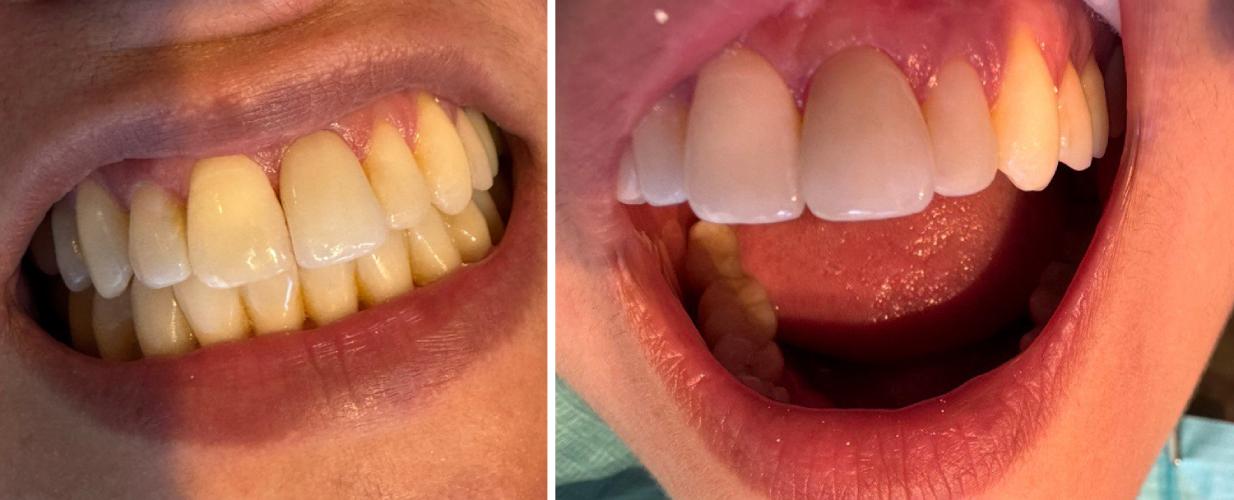 Replacing a failed crown in the smile zone: from “artificial” to “natural”