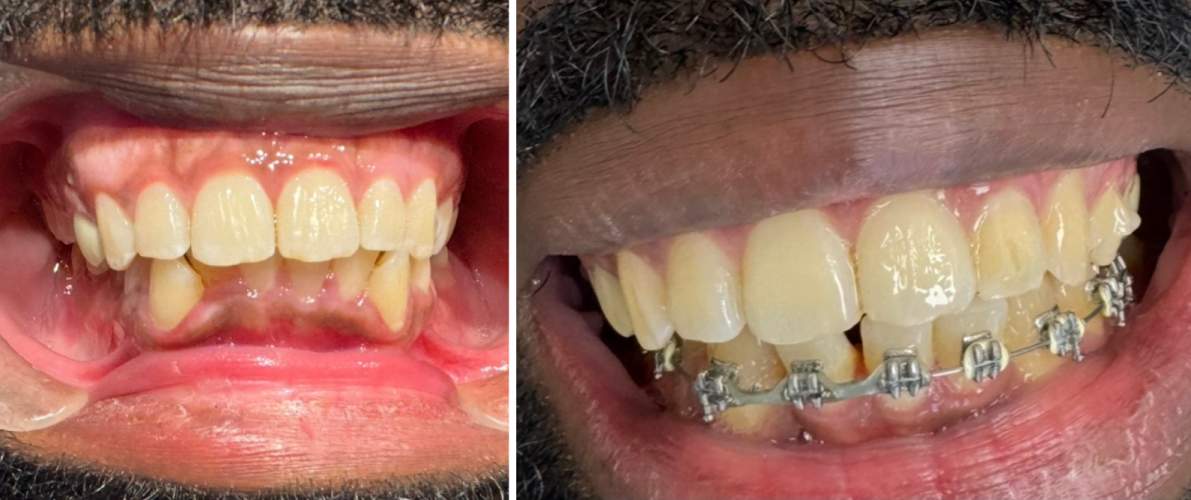 Correcting Severe Lower Tooth Crowding with Braces
