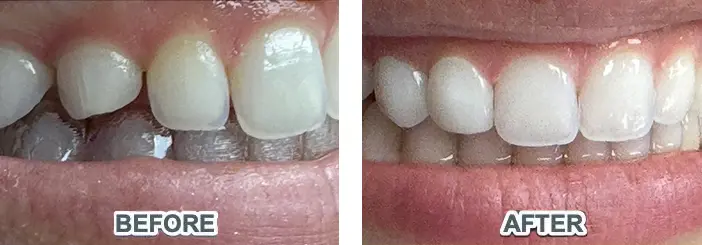 Placement of Lumineers on Two Teeth