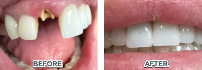 Implant Placement with Immediate Crown Loading